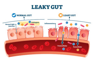 Diagram showing the difference between a healthy gut and leaky gut.